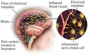 This illustration shows how nerve fibers become inflammed during a migraine.